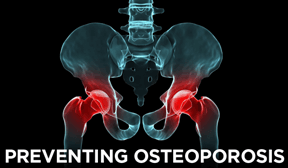 osteoporosis graphic